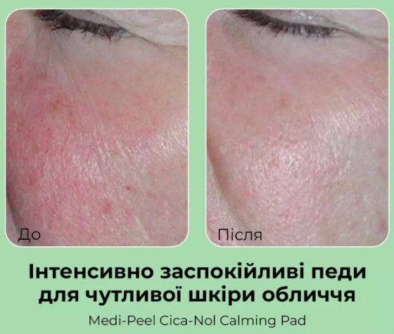 Medi-Peel Phyto Cica-Nol B5 Calming Pad - Успокаивающие пилинг-диски для чувствительной кожи лица - 2